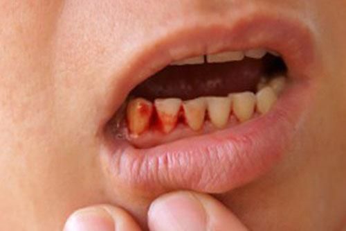 Khi bị chảy máu chân răng hãy đi khám ngay đừng chủ quan kẻo hối hận thì quá muộn