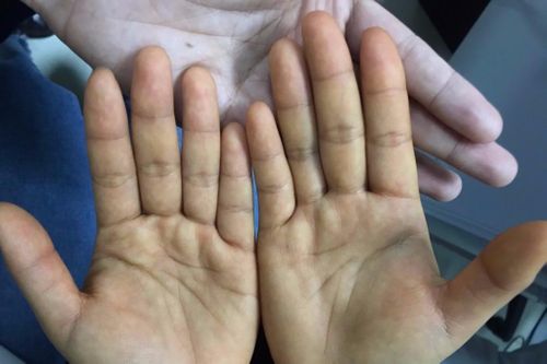 Vàng da do ăn quá nhiều đu đủ, cà rốt