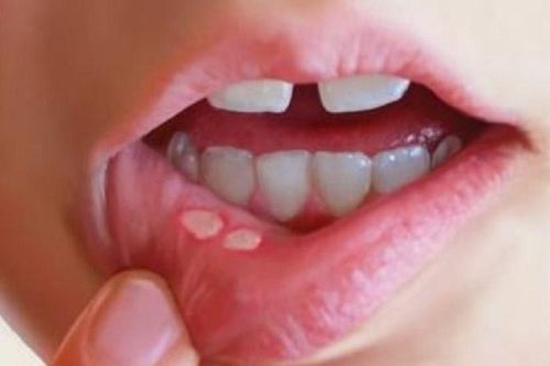 Nấm miệng là gì? Những điều cần biết về bệnh nấm miệng