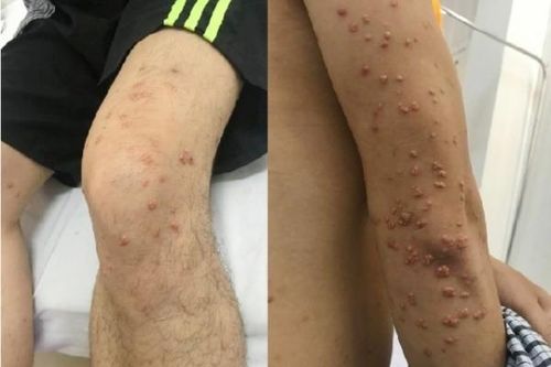 U vàng phát ban - Cẩn thận bệnh lý tiềm ẩn