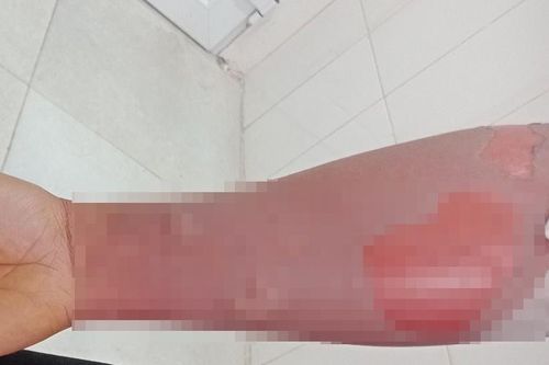 Người đàn ông bị loét da sau khi tắm bằng lá cây