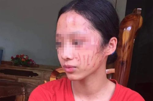 Nữ sinh cào mặt nhau, hai gia đình tự giảng hòa