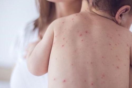 Cảnh giác bệnh thủy đậu