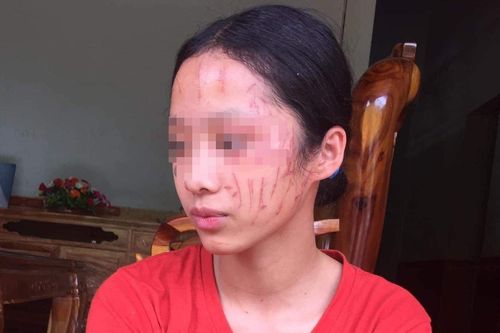 Điểm nhấn giáo dục: Nữ sinh lớp 8 bị 'đàn chị' cào nát mặt