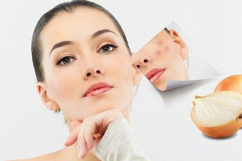 Chỉ với một củ hành tây bạn đã có ngay mẹo xóa tan sẹo thâm