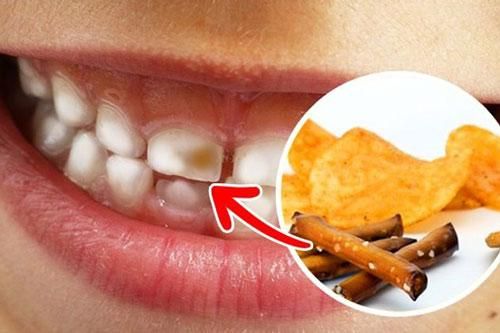 Những thực phẩm gây hại cho sức khỏe răng miệng người dùng cần tránh