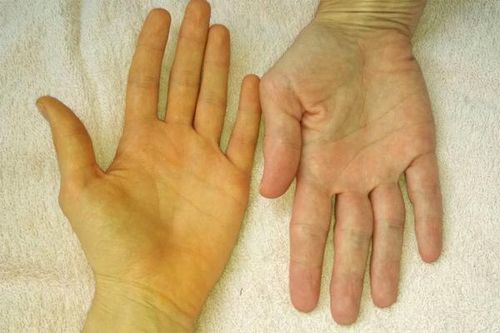 ''3 vàng 1 đen'' là dấu hiệu cảnh báo gan của bạn đang suy mòn