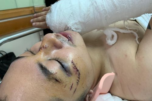 Vụ thủng sàn chung cư: Nạn nhân bị gãy xương sống