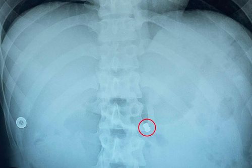 Nam thanh niên bị bắn thủng bụng khi đi trộm chó