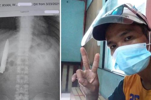 Người đàn ông bị dao găm trong ngực hơn 1 năm mà không biết