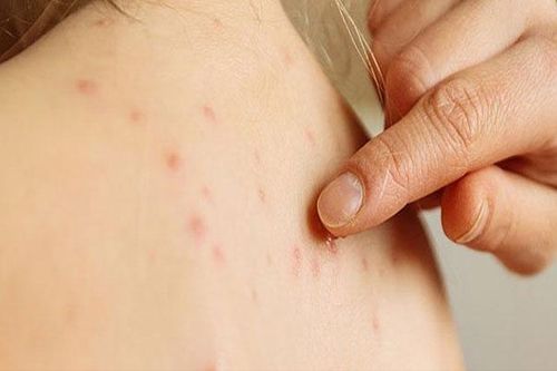 3 sai lầm 'kiêng cữ' trong chăm sóc bệnh nhân thủy đậu cần bỏ ngay