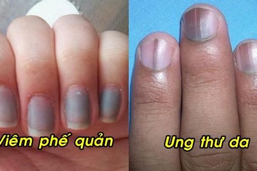 Dấu hiệu trên móng tay cảnh báo căn bệnh nguy hiểm