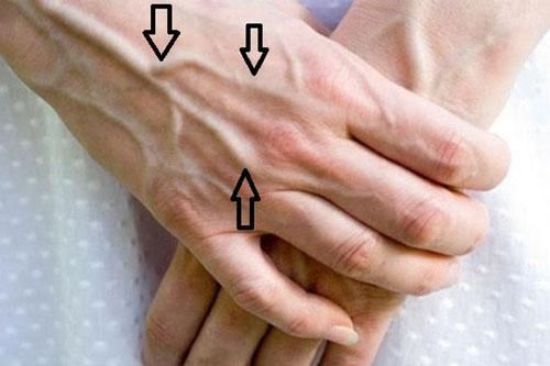 Gân xanh nổi lên chằng chịt ở những chỗ này cảnh báo căn bệnh nguy hiểm
