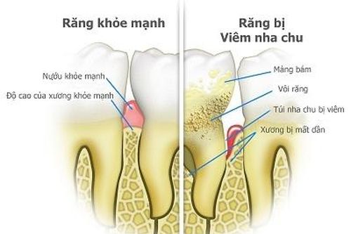 Viêm nha chu có liên quan đến tăng huyết áp