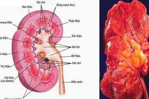 Bài thuốc hỗ trợ trị viêm cầu thận cấp