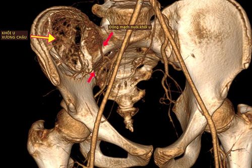 Không chủ quan với cơn đau xương chậu ở tuổi dậy thì