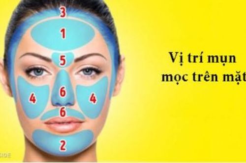 Vị trí mụn trên cơ thể cảnh báo bệnh gì?