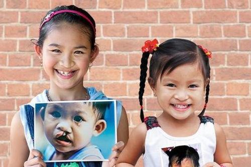 Để tiếng cười trọn vẹn thành hiện thực cho trẻ em hở môi, hàm ếch