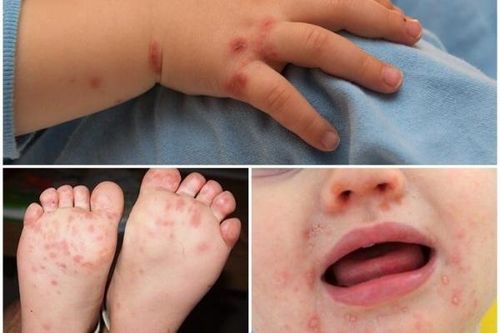 Trẻ mắc tay chân miệng chủ yếu do nuốt phải virus nhưng phòng bệnh không hề khó