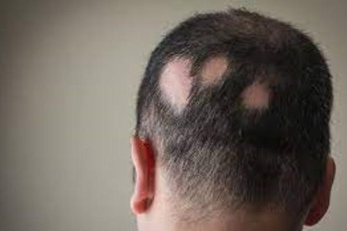 Phương pháp mới ngăn chặn rụng tóc do căng thẳng