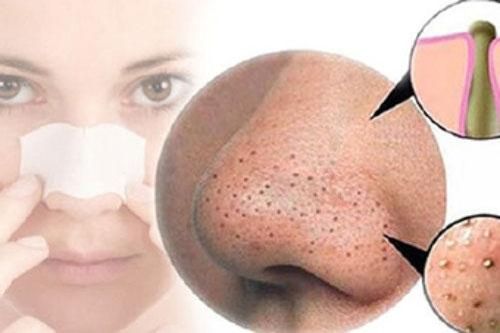 Bí quyết nặn mụn đầu đen hiệu quả không kém đi Spa