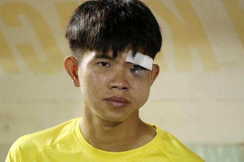 Cầu thủ bị gãy xương gò má tại giải hạng Nhất