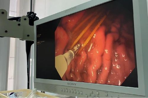 Nuốt tăm tre trong lúc ngủ, người đàn ông phải nhập viện cấp cứu