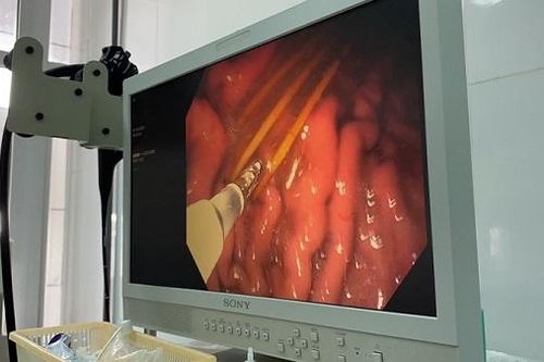 Lấy 3 cây tăm tre trong dạ dày bệnh nhân