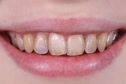 Ăn uống sai cách là nguyên nhân gây hỏng răng