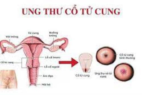6 dấu hiệu cảnh báo buồng trứng có bệnh chị em nên cảnh giác
