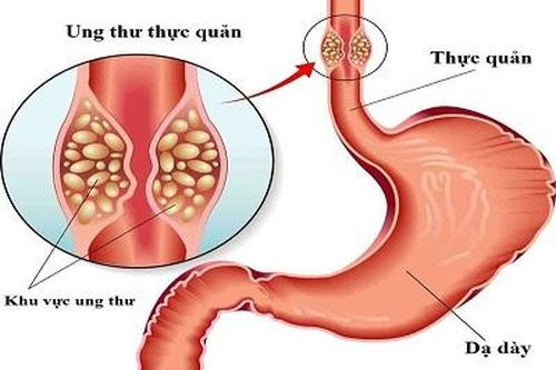 Thuốc tăng cường miễn dịch giúp kéo cuộc sống ở người ung thư thực quản