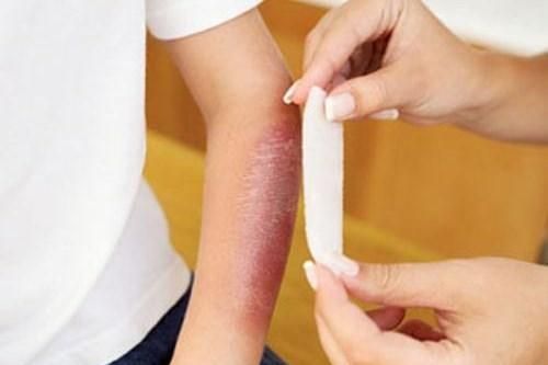 Cách sơ cứu khi bị bỏng da cần nắm được