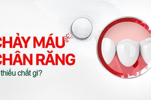 Chảy máu chân răng là thiếu chất gì, điều trị thế nào nhanh khỏi?