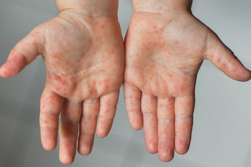 Dịch tay chân miệng bùng phát phức tạp