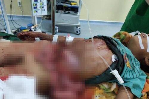 Cứu sống bệnh nhân bị vỡ toạc ngang thành bụng