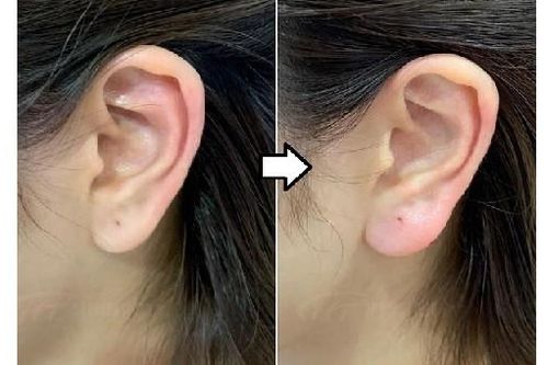Tiêm tai tài lộc – coi chừng nhận 'trái đắng'