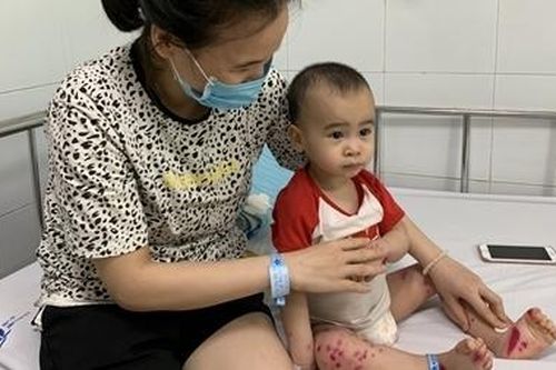 4 người tử vong vì tay chân miệng