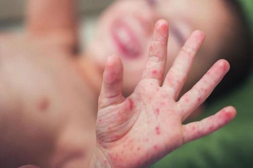 Bệnh tay chân miệng vào mùa, cha mẹ nên cẩn trọng ngay cả khi trẻ ngủ
