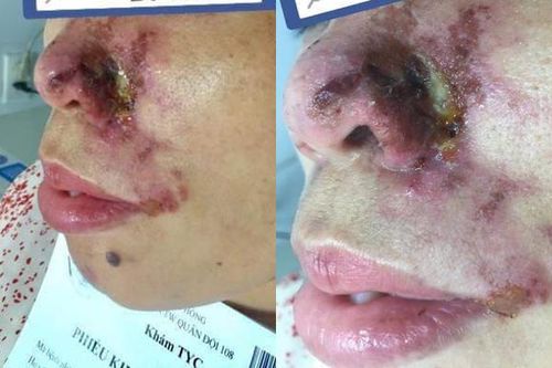 Làm đẹp bằng filler: Cẩn trọng thương tật vĩnh viễn