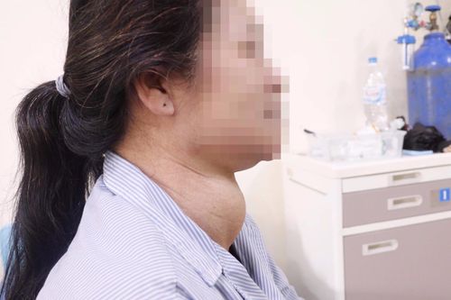 Người phụ nữ mang khối u khổng lồ ở cổ