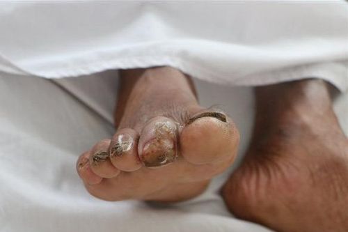 Cứu sống người đàn ông nhiễm vi khuẩn 'ăn thịt người'