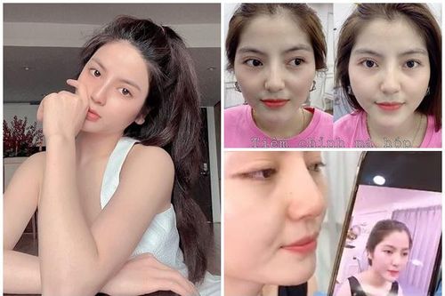 Lộ ảnh tình tin đồn Quang Hải nâng mũi, bơm má, độn cằm