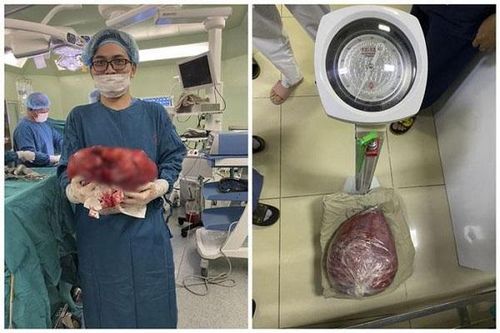 Khối u khủng trong ổ bụng, bác sĩ 20 năm chỉ gặp 2 lần
