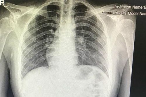Chàng trai ở Hà Nội có trái tim bên phải