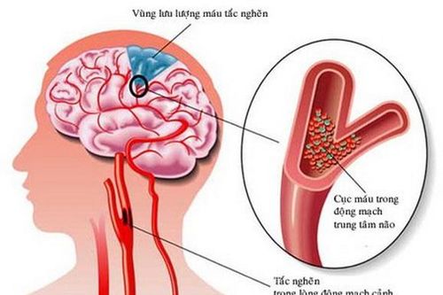 Đột quỵ vì tự dừng thuốc chống đông máu