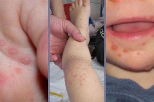 Bệnh tay chân miệng: Tự ý dùng thuốc là gây hại cho trẻ