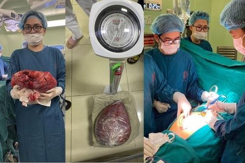 Nghĩ mình bị béo, người phụ nữ 42 tuổi đi khám phát hiện mang khối u khổng lồ