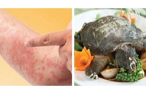 Người đàn ông sốc phản vệ sau khi ăn thịt ba ba