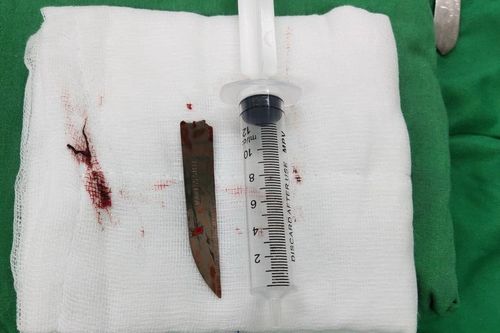 Lấy thành công mũi dao đâm vào cột sống bệnh nhân
