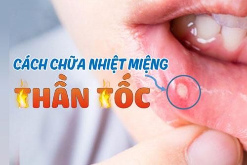 Bị nhiệt miệng cứ thử 1 mẹo đơn giản, hết sưng đau nhanh bất ngờ